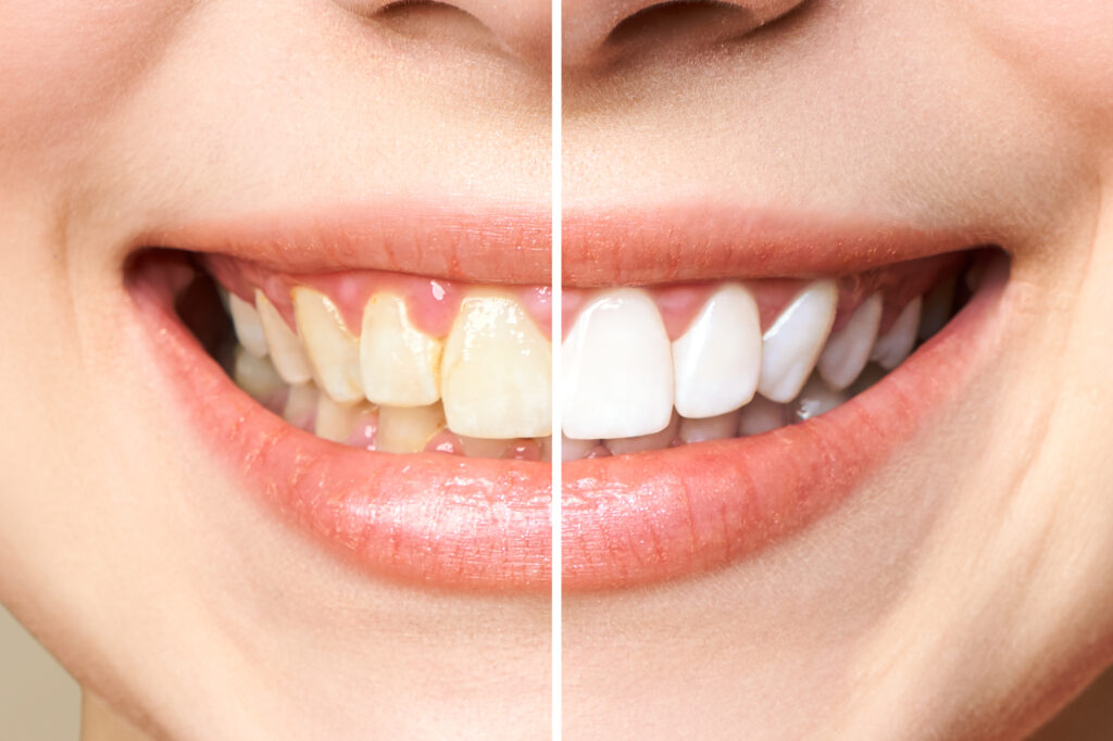 seattle teeth whitening